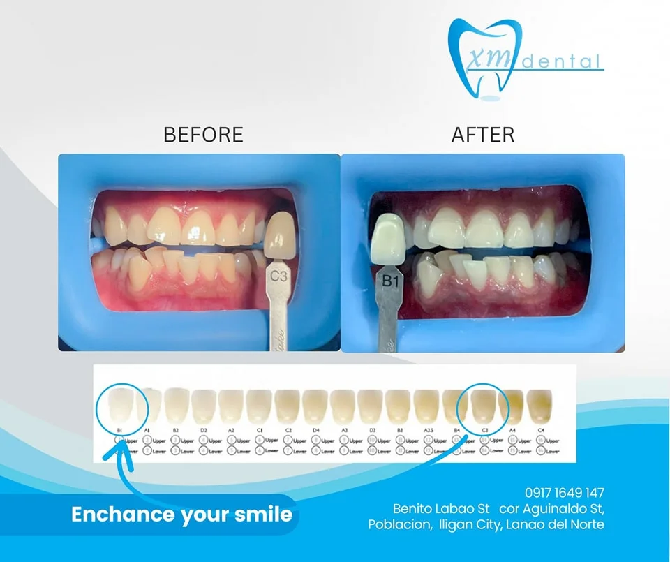 Teeth Whitening Service in Iligan City - XM Dental